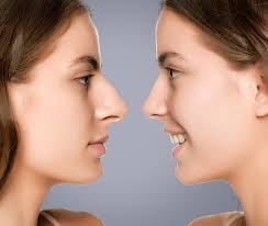 Nose Job Boston, MA: Expert Rhinoplasty Surgeons for Your Perfect Nose